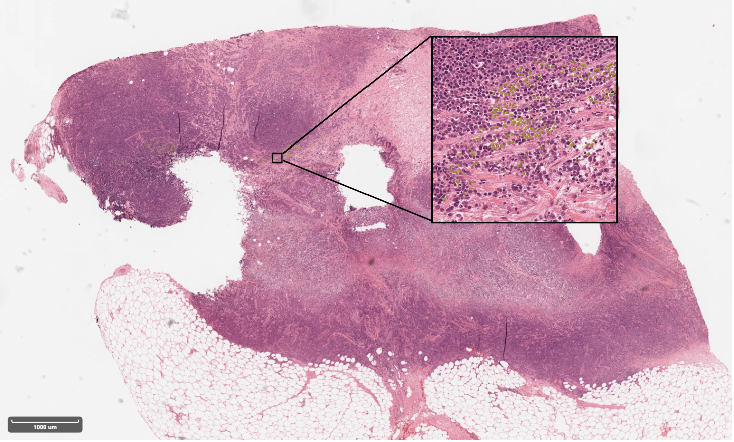 Lymphocytes filtered within the tumor associated stroma