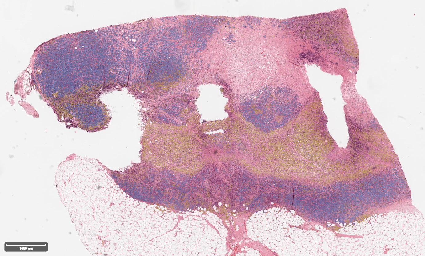 Nuclei instance segmentation overlay generated using KongNet PUMA T2 3