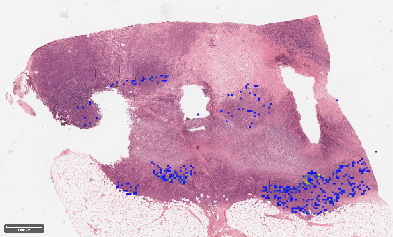 sTIL density map