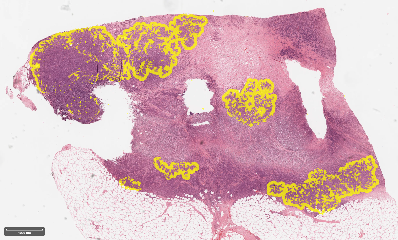 Tumor associated stroma overlay